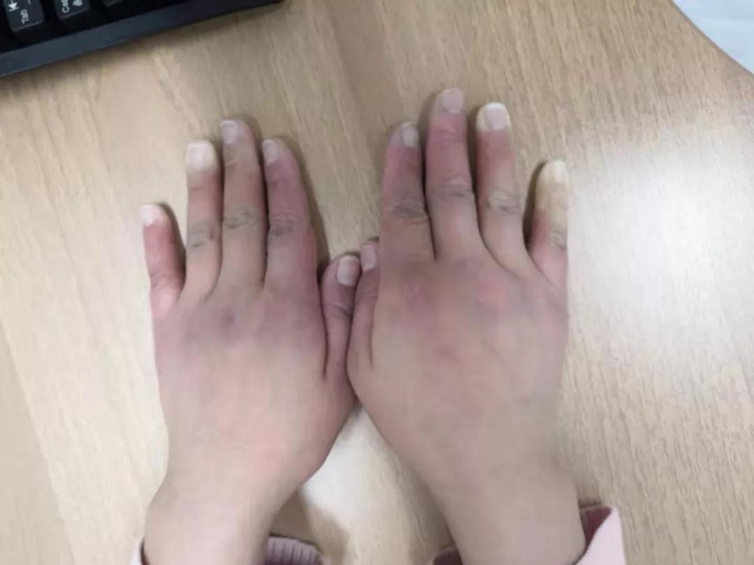 “手指、腳趾發(fā)白、發(fā)紫……”這些“小毛病”千萬別大意