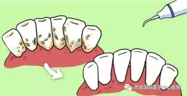 牙齒上的黃斑好難看，三招告訴你如何預(yù)防氟斑牙