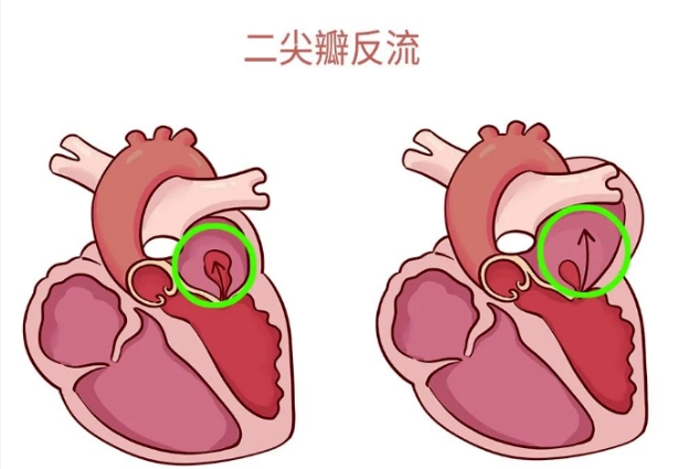 體檢報(bào)告里的心臟瓣膜反流，你讀懂了嗎？