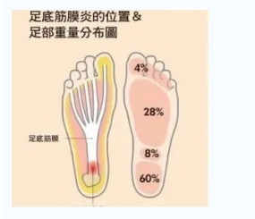 每年新生數(shù)百萬足底筋膜炎患者！國際醫(yī)學(xué)專家提醒：跑步要選擇合適的鞋