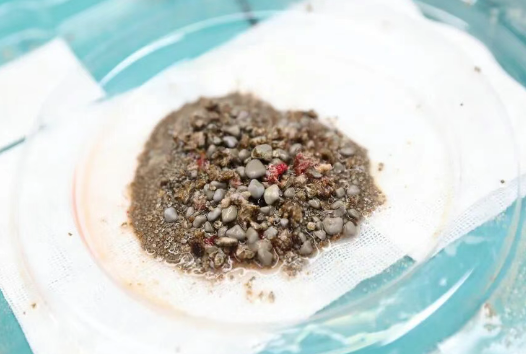 密集恐懼癥慎入！男子腎臟里取出上萬顆沙石