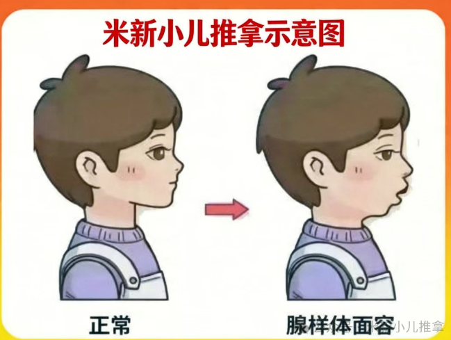 兒童腺樣體肥大只能手術(shù)？不，一位媽媽的親身經(jīng)歷給出另一種答案